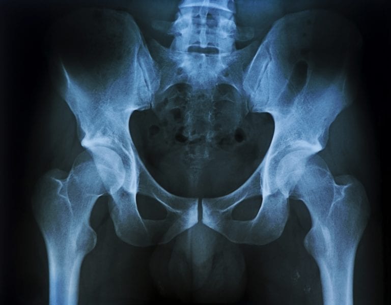 Average Workers' Comp Settlement Amounts for Hip Injuries