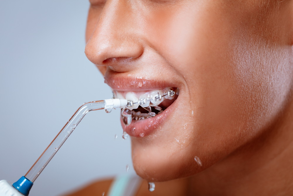 Is it Safe to Use a Waterpik for Braces? Innovative Orthodontic Centers