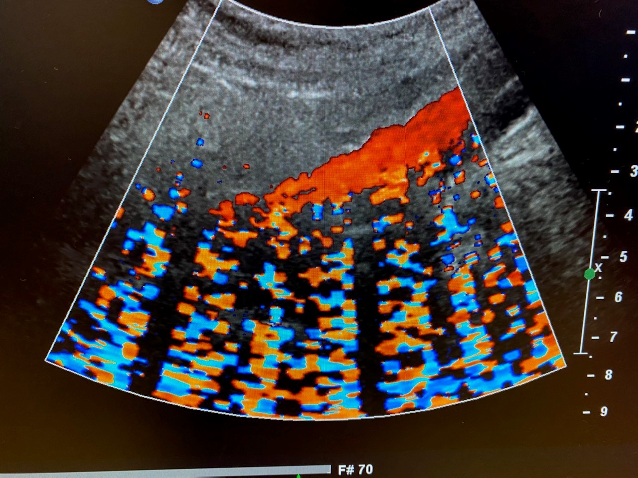 Root causes of noise artifacts in ultrasound images Innovatus Imaging