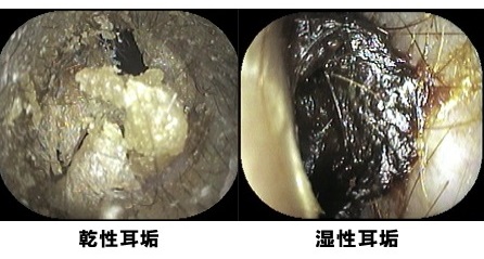 危険❗綿棒は耳に突っ込んではいけません、正しい耳掃除の方法は意外でした。(院長ブログ) - 五本木クリニック 耳あか - いのうえ耳鼻咽喉科