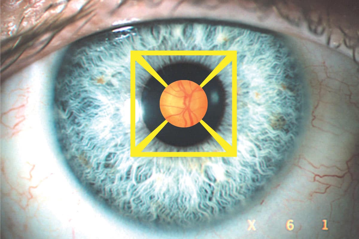 Primary open angle An eye disease of something