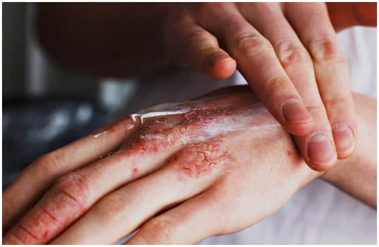 Eczema Spiritual Meaning, Causes and Healing Insight state