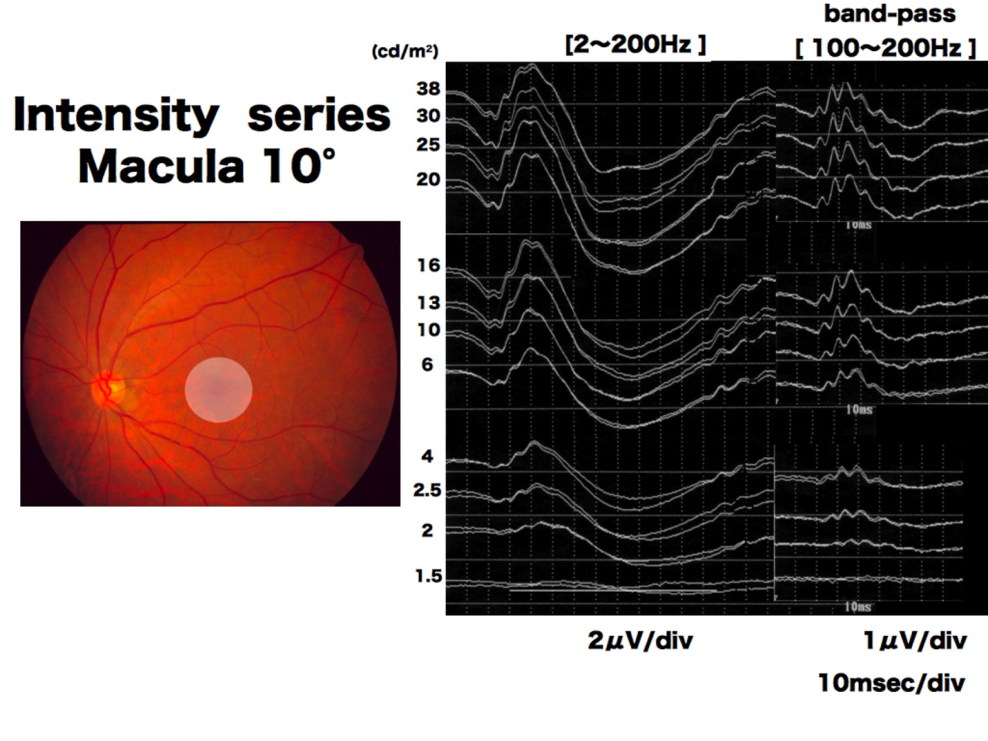 Objective Assessment of Local Retinal Function by Focal Macular and