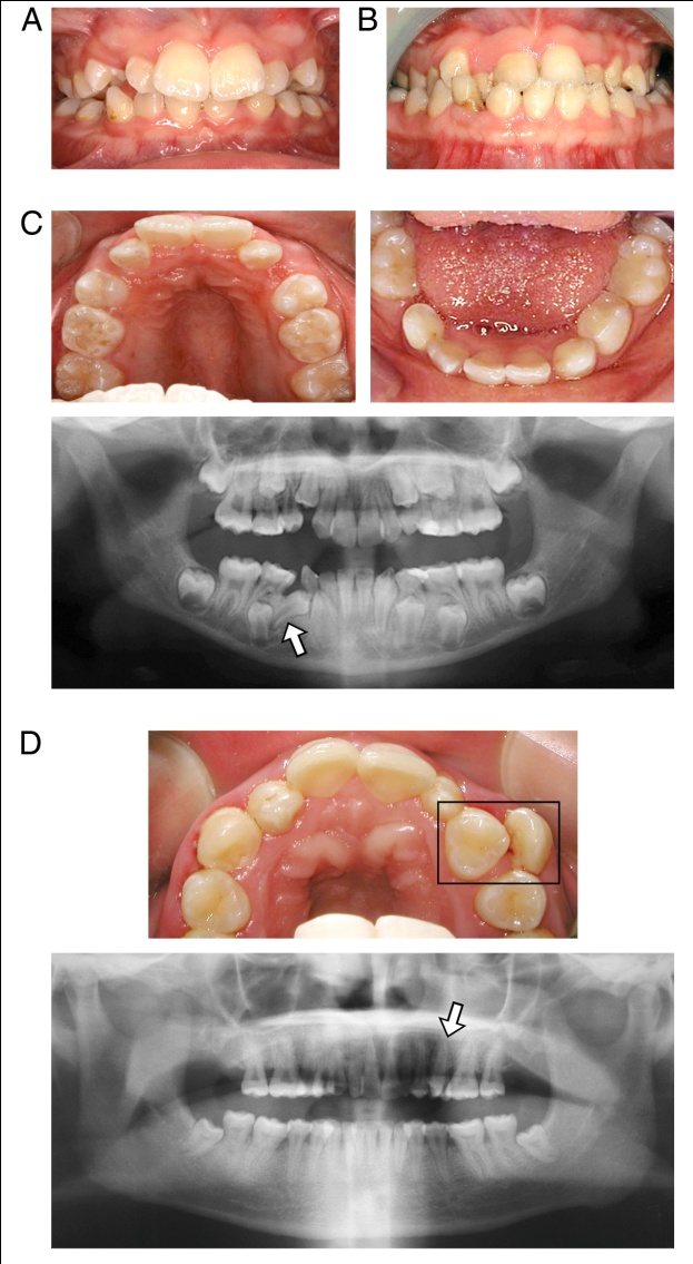 Oral Health in Individuals with Down Syndrome IntechOpen