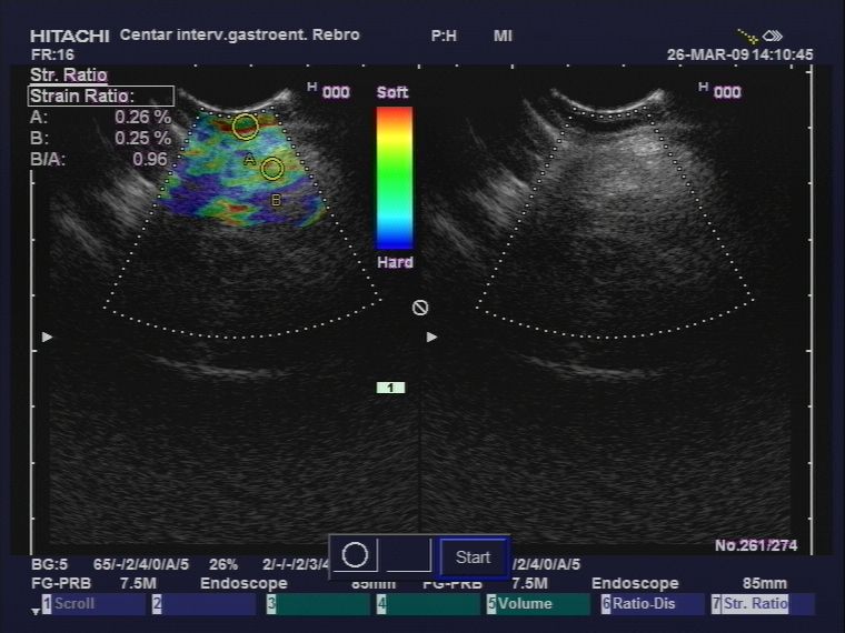 Endoscopy For The Diagnosis Of Inflammatory Bowel Disease Intechopen