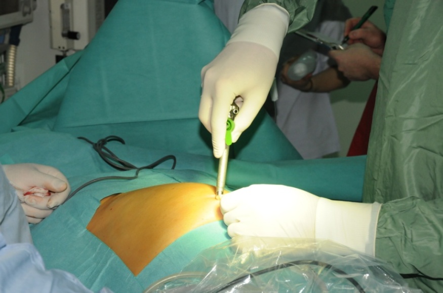 Laparoscopic Access Techniques IntechOpen