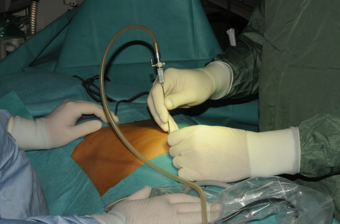 Laparoscopic Access Techniques IntechOpen