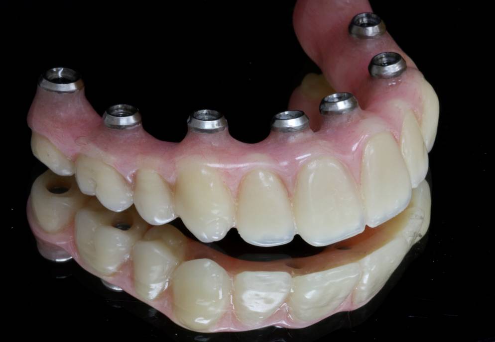 StateoftheArt Technology in Implant Dentistry CAD/CAM IntechOpen