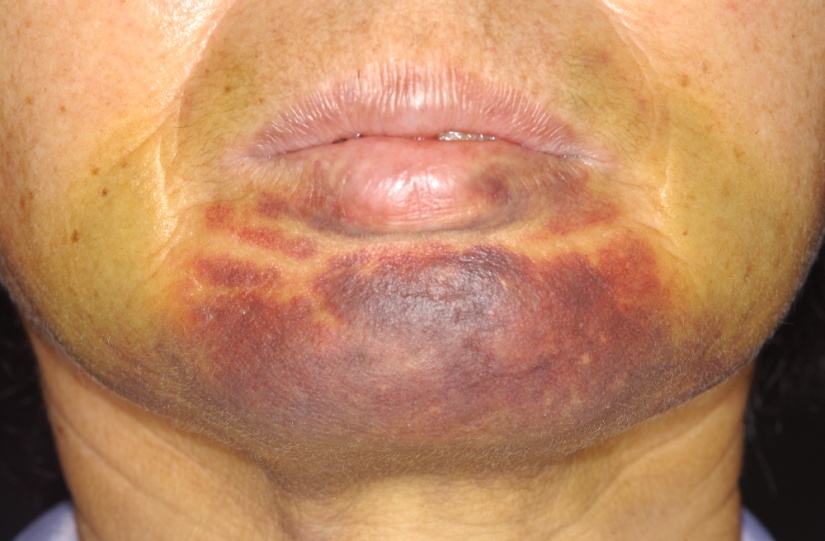 Clinical Complications of Dental Implants IntechOpen