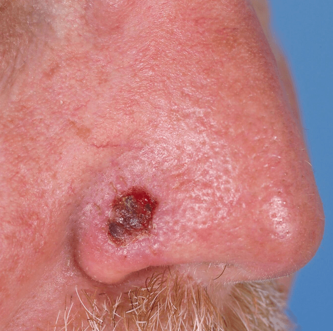 Lower Third Nasal Skin Grafting IntechOpen