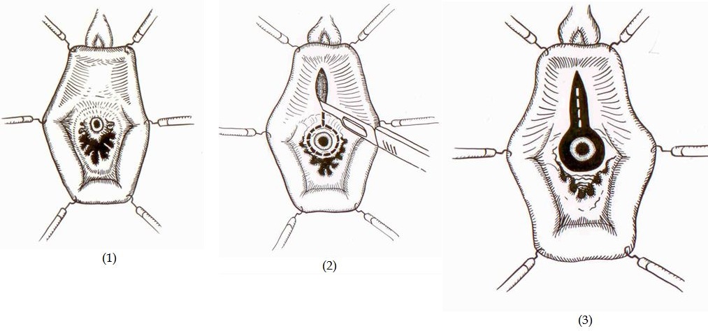 Urethral Caruncle Causes Symptoms And Treatment