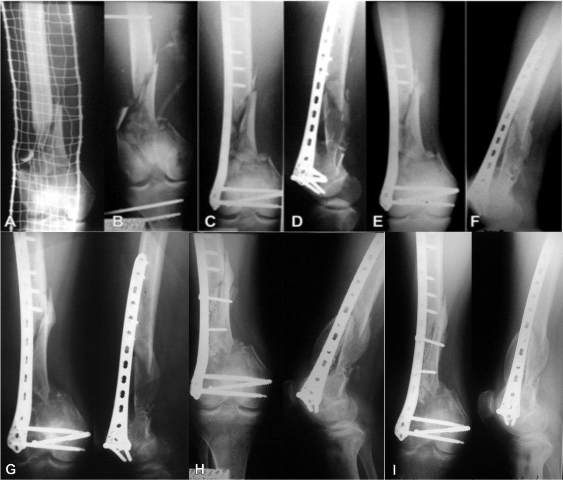 Minimally Invasive Plate Osteosynthesis (MIPO) in Long Bone Fractures