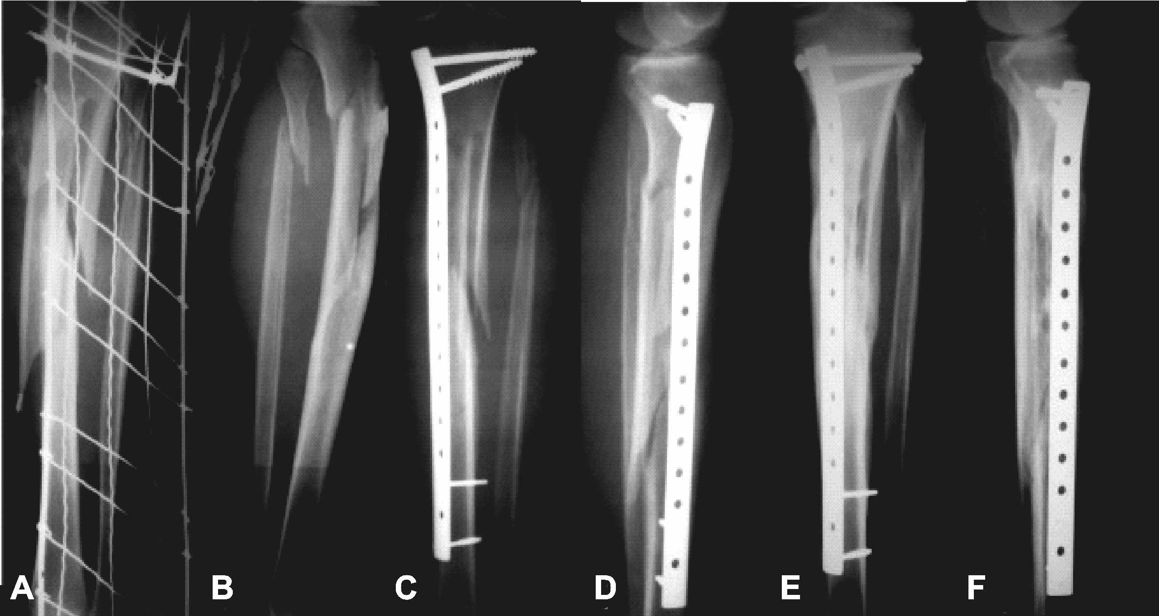 Minimally Invasive Plate Osteosynthesis (MIPO) in Long Bone Fractures