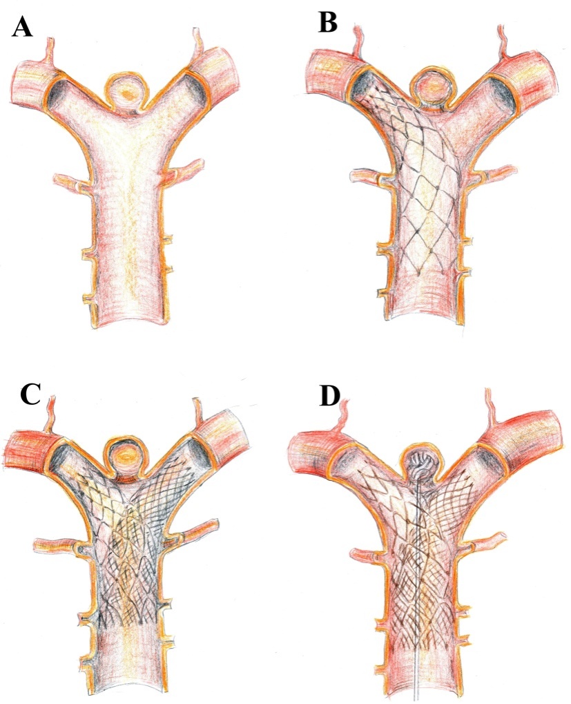 StentAssisted Techniques for Intracranial Aneurysms IntechOpen