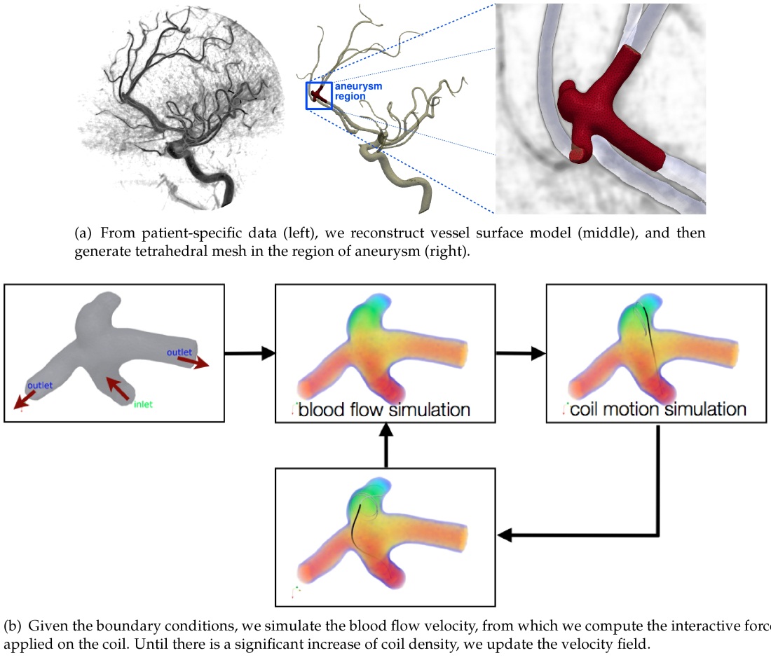 A (Near) RealTime Simulation Method of Aneurysm Coil Embolization