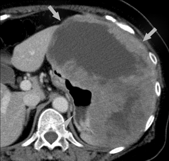 Imaging Findings of Gastric Carcinoma IntechOpen