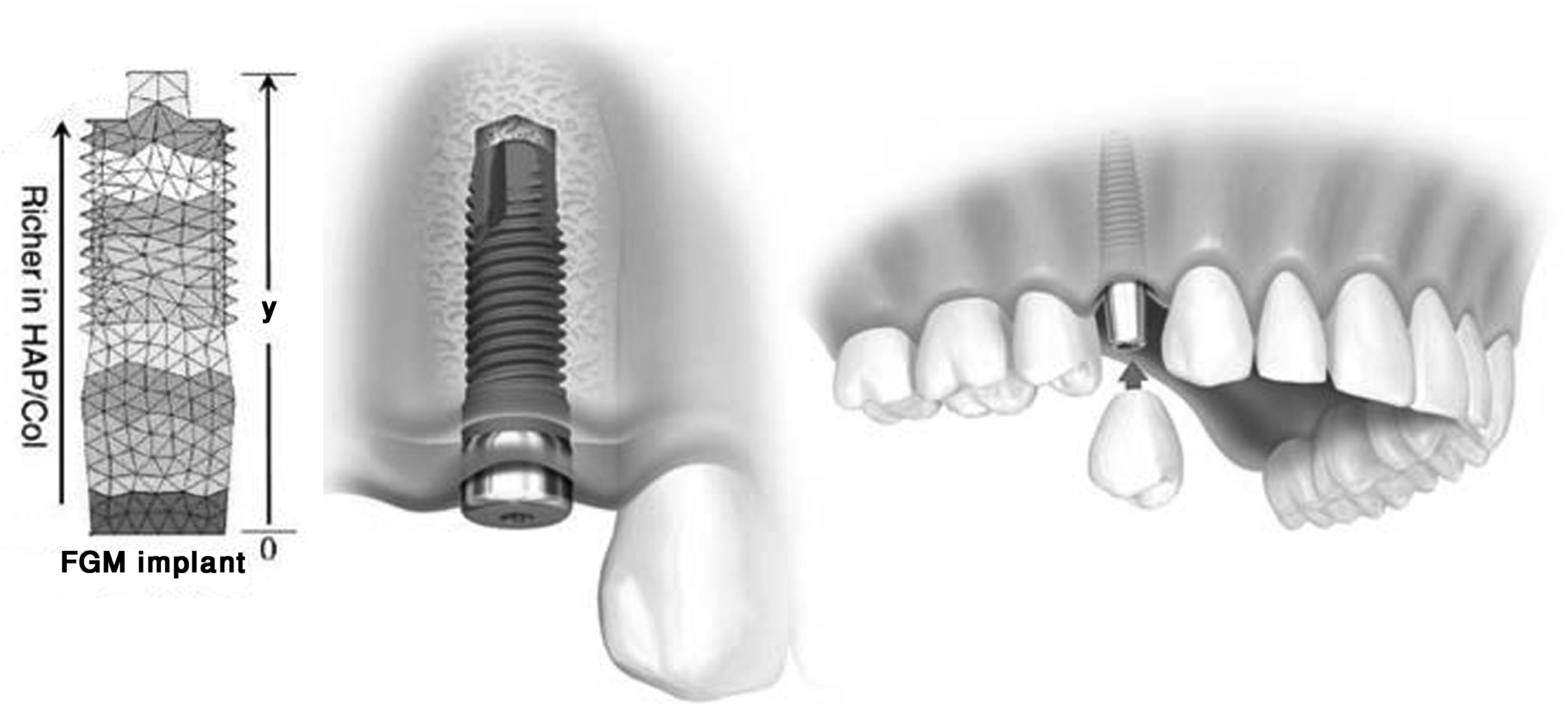 Optimum Functionally Gradient Materials for Dental Implant Using