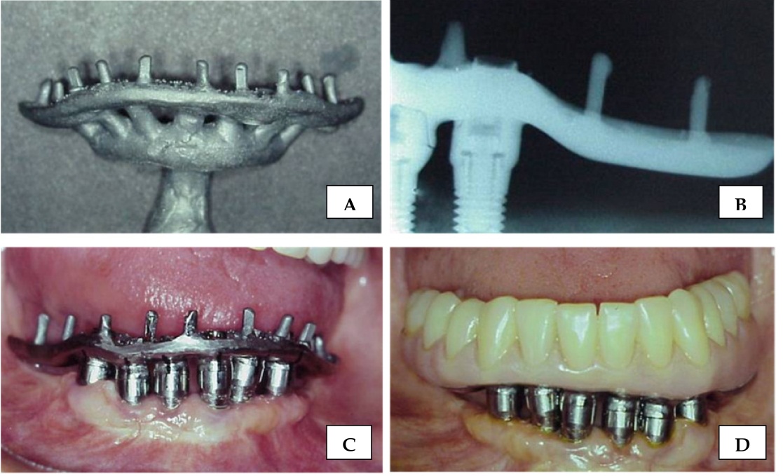 Welding Techniques in Dentistry IntechOpen