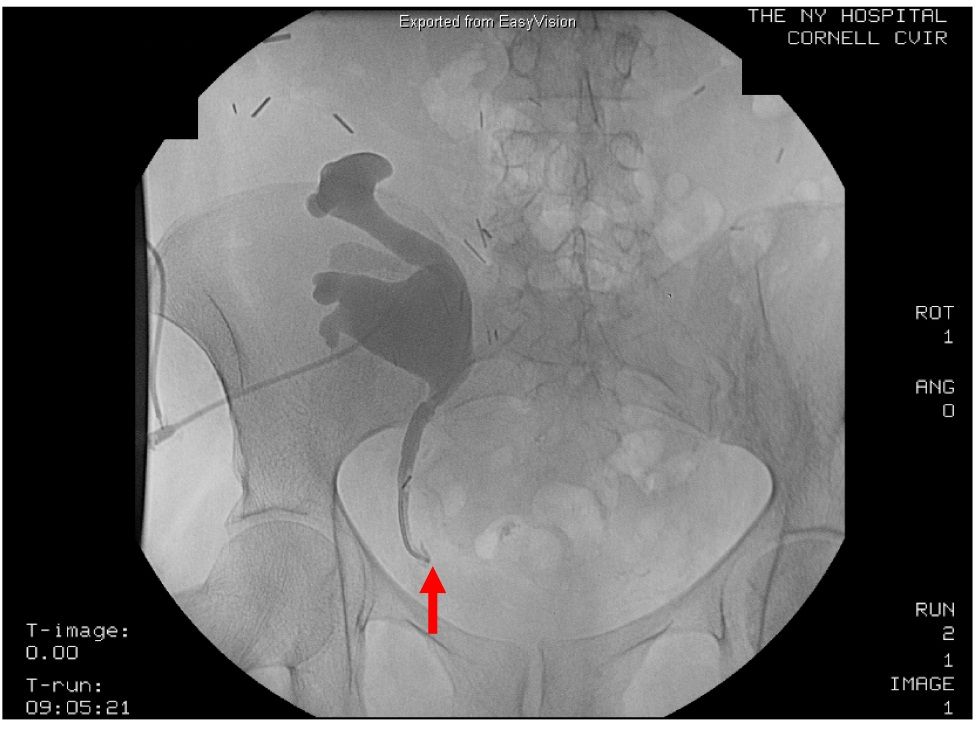 Surgical Management of the Kidney Transplant Recipient IntechOpen
