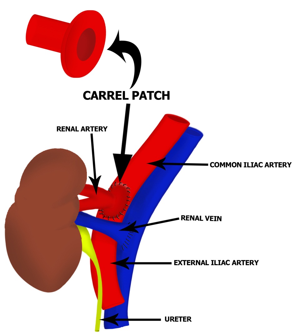 Expanding Opportunities for Kidney Transplantation IntechOpen