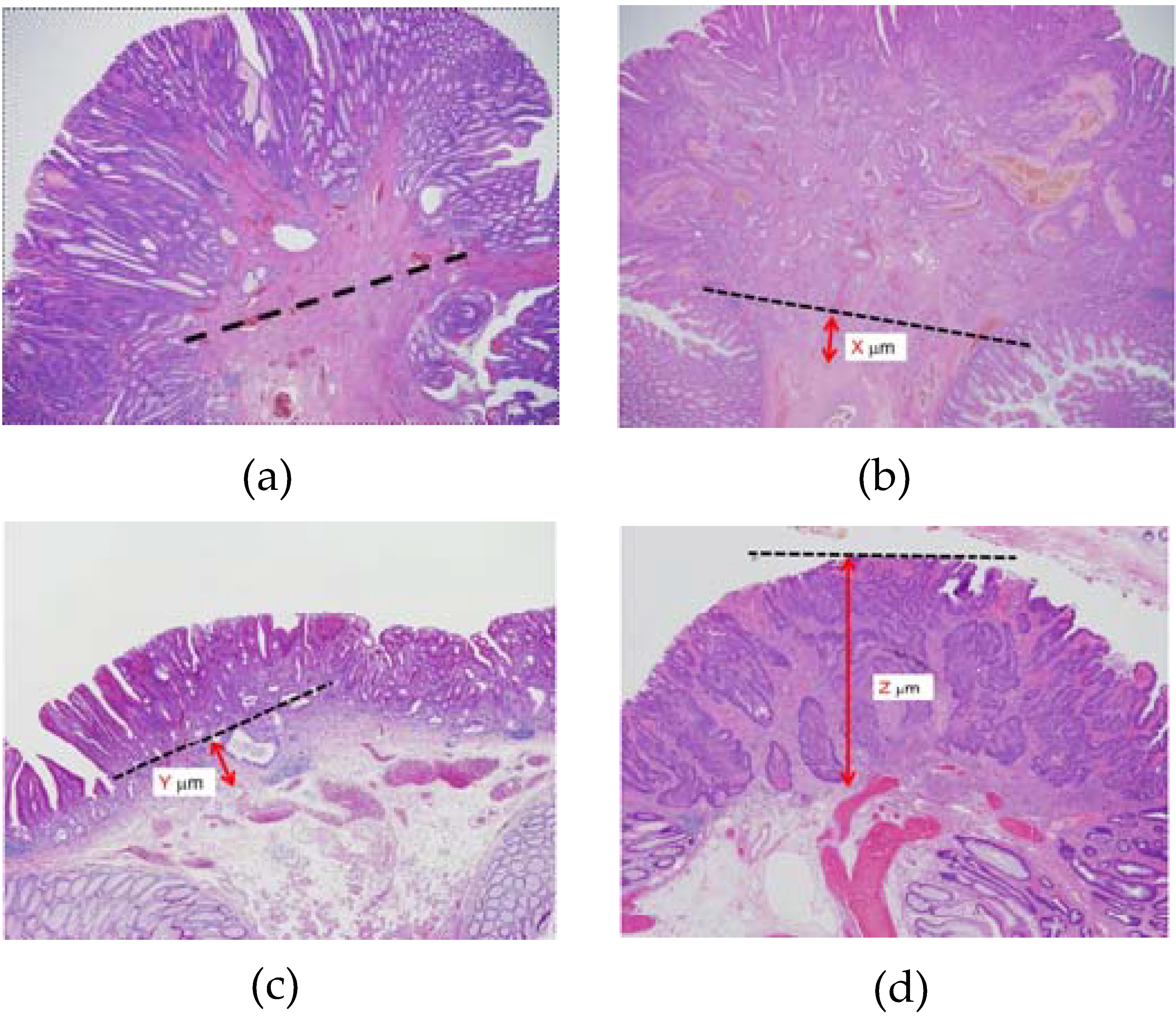 Desmoplastic Reaction in Biopsy Specimens of T1 Stage Colorectal Cancer
