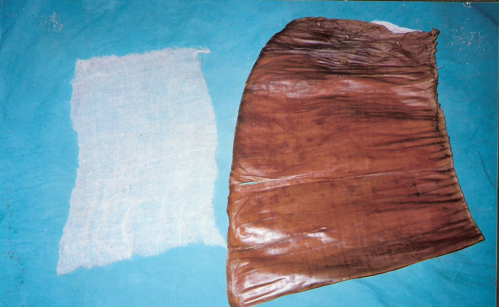 Polyethylene Surgical Drape Dressing for Split Thickness Skin Graft