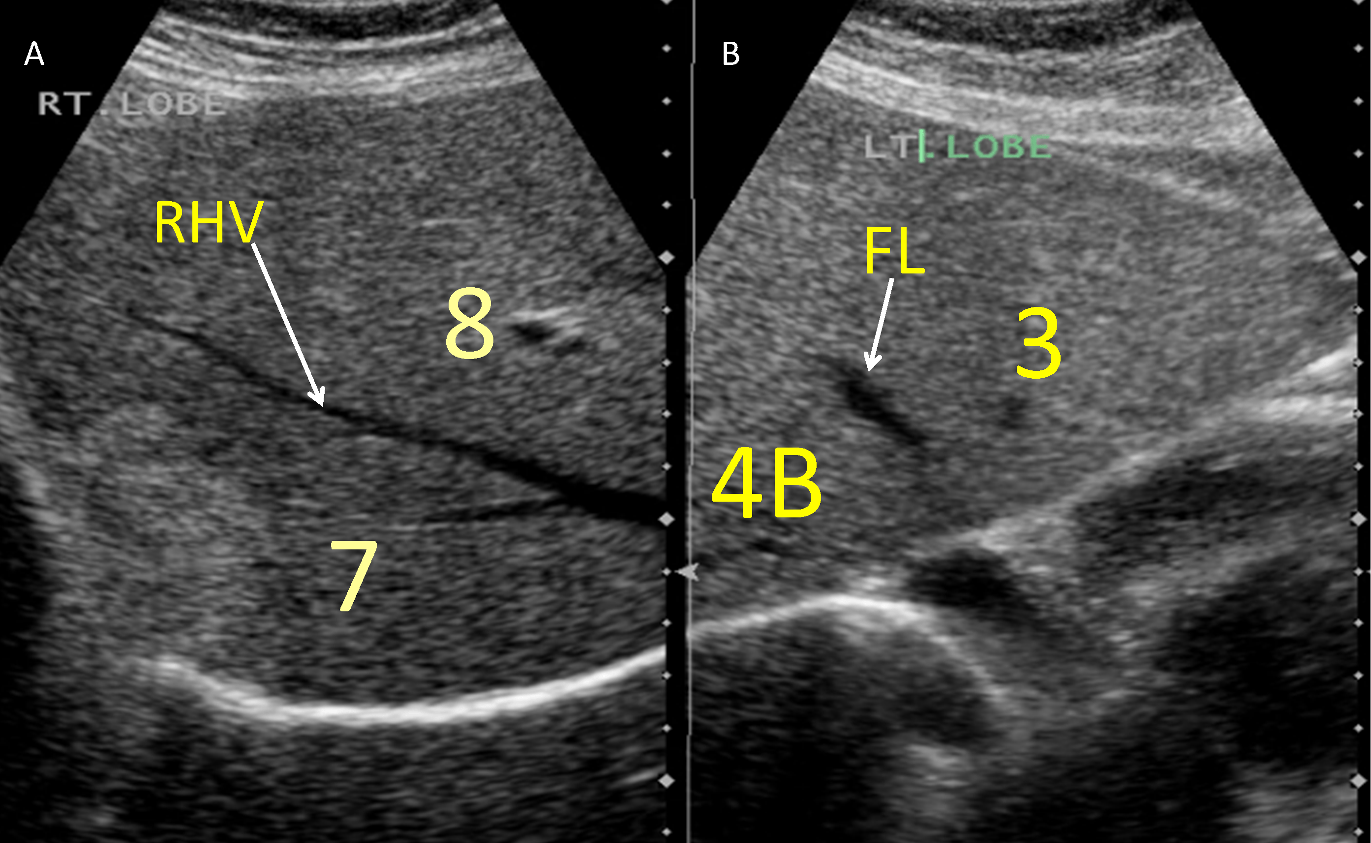 Liver Ultrasound Anatomy Anatomical Charts & Posters