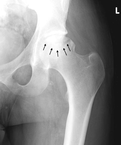 “NeckSparing” Total Hip Arthroplasty IntechOpen
