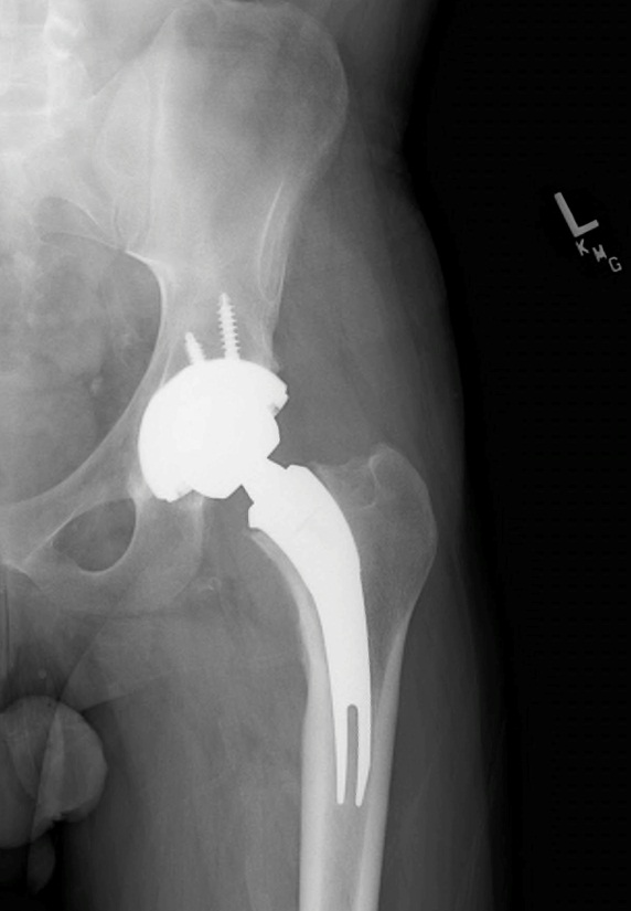 “NeckSparing” Total Hip Arthroplasty IntechOpen