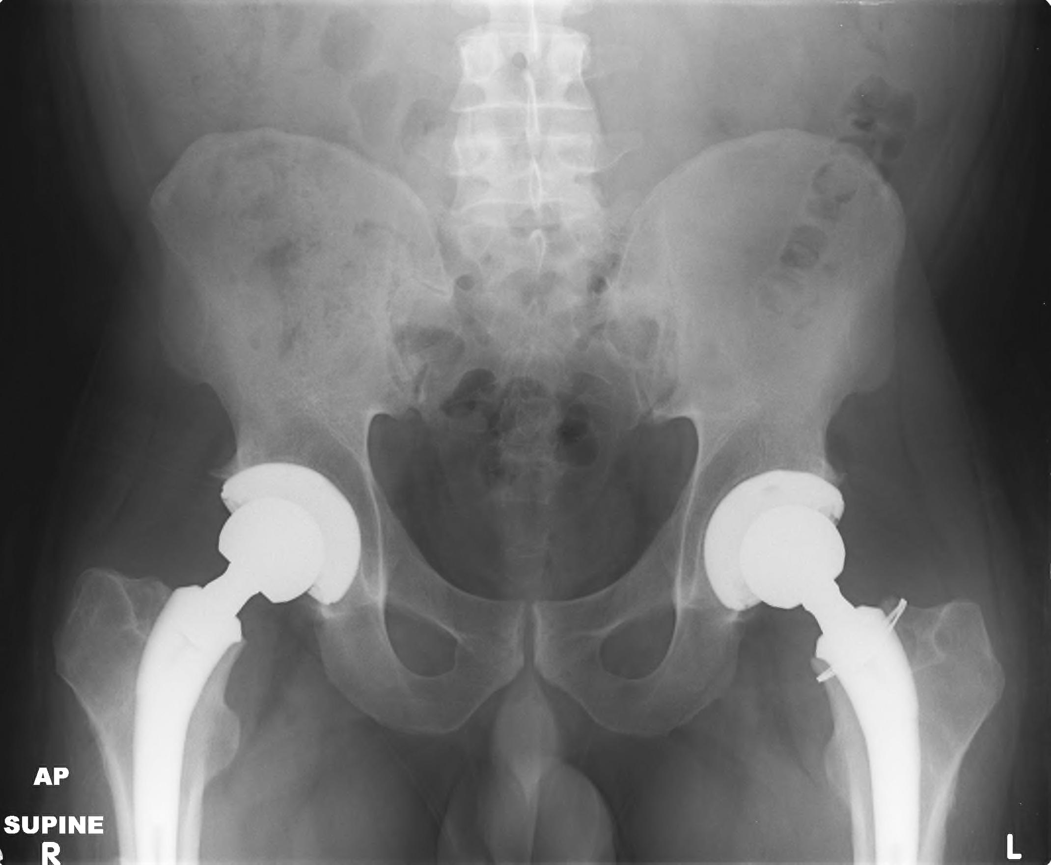 “NeckSparing” Total Hip Arthroplasty IntechOpen