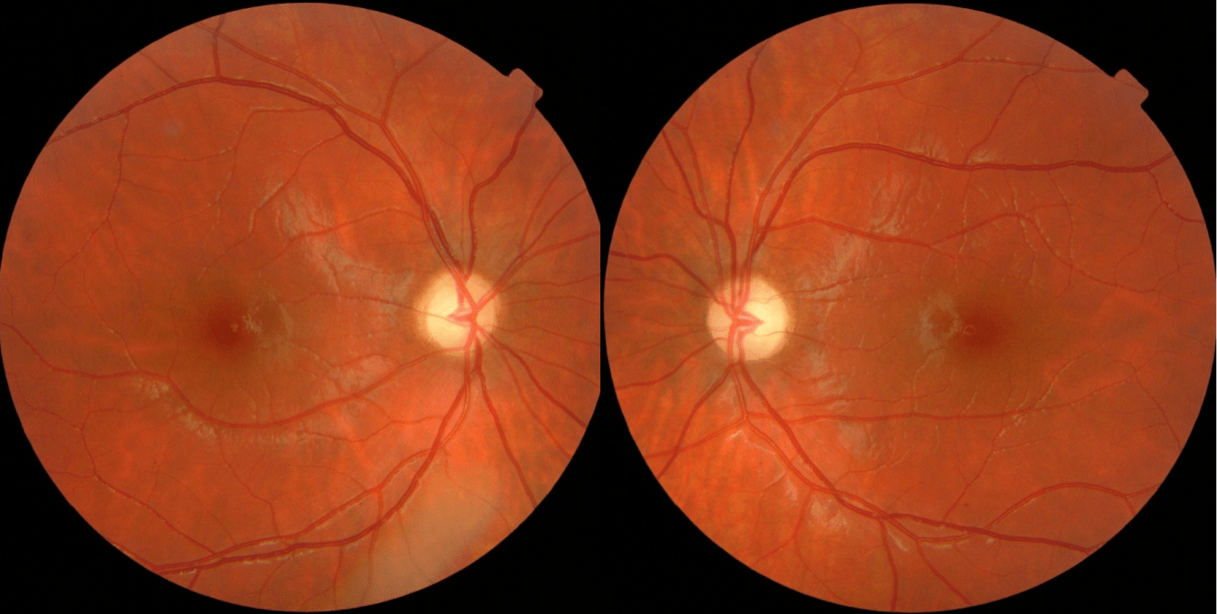 Optical Coherence Tomography in NeuroOphthalmology IntechOpen