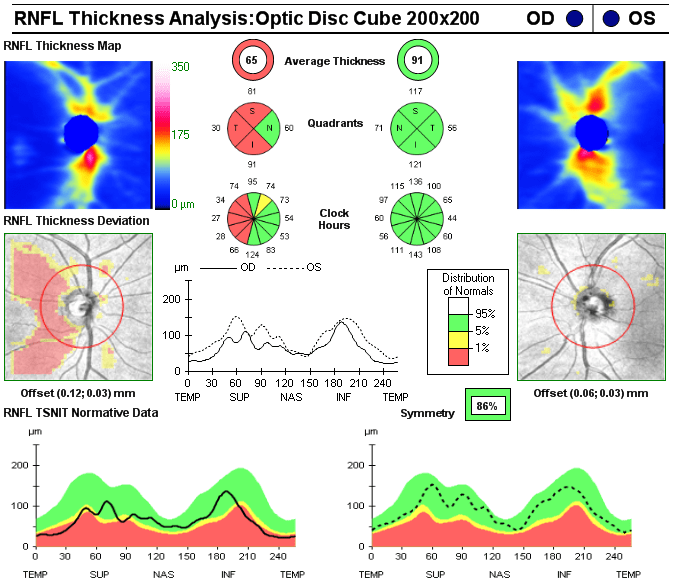 Optical Coherence Tomography in NeuroOphthalmology IntechOpen