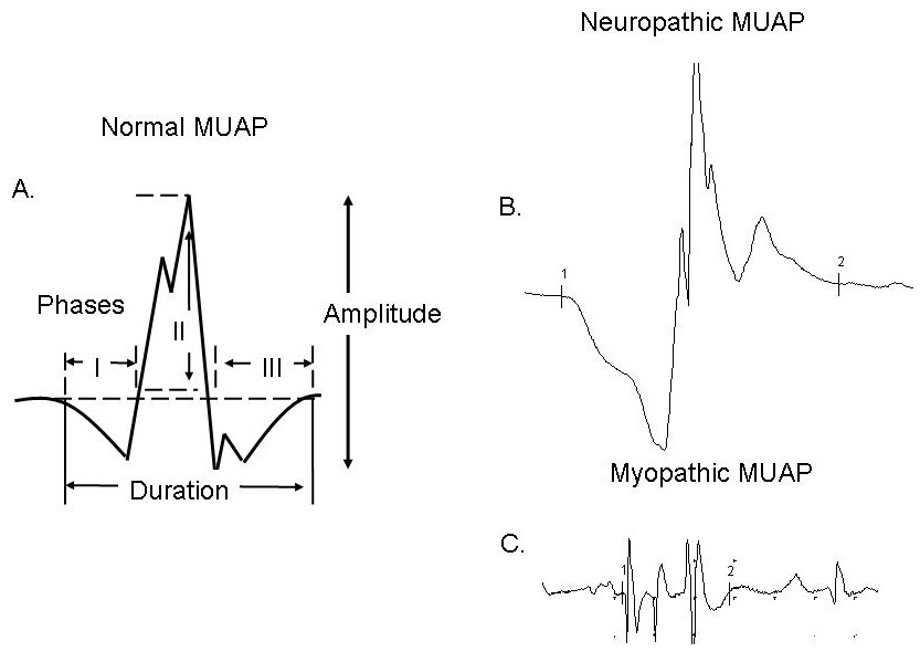 Overview of the Application of EMG Recording in the Diagnosis and