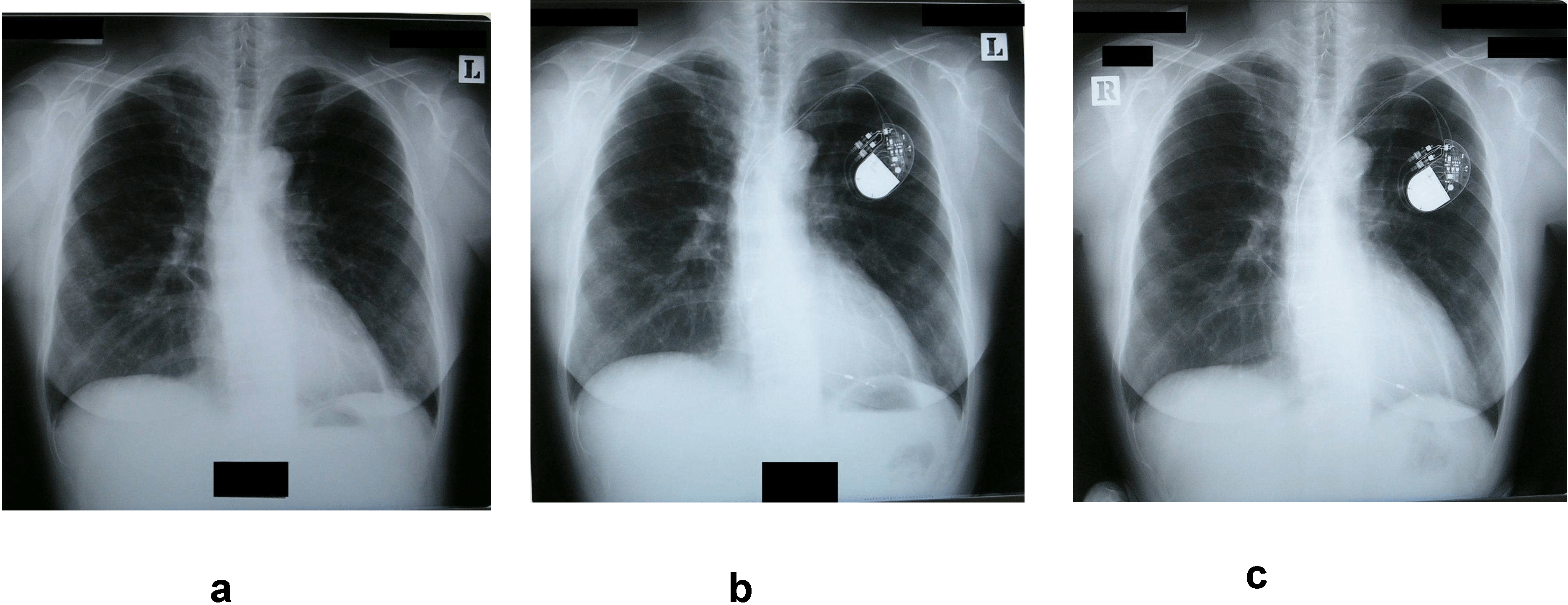 Chest X Ray Smoker Vs Nonsmoker