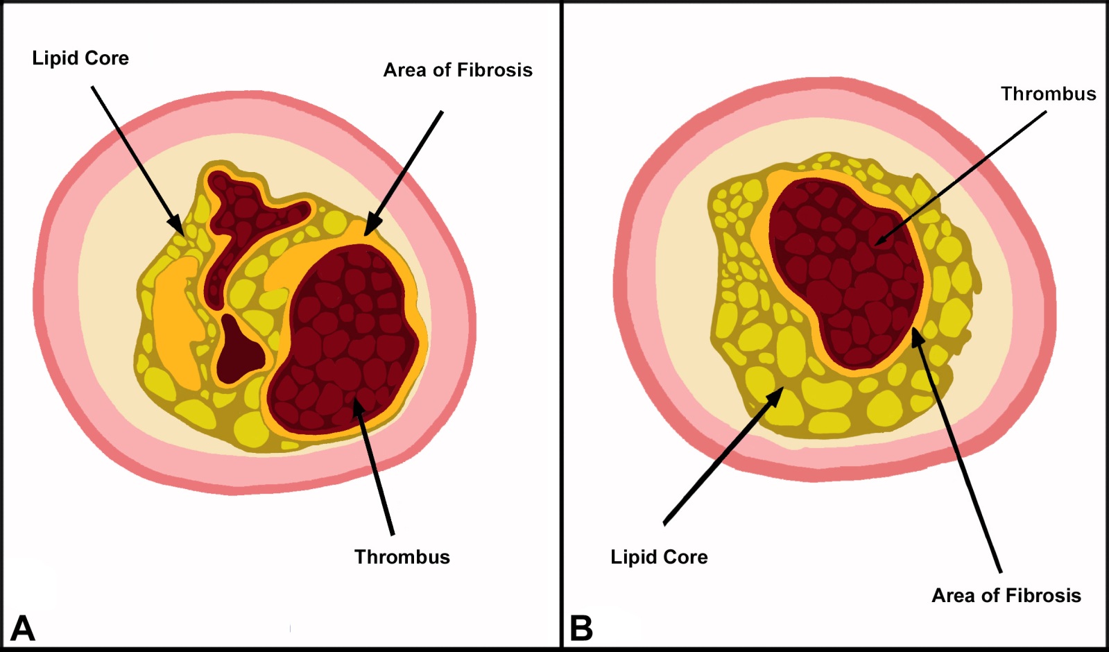 Percutaneous. Recanalization of Chronic Total Occlusion (CTO) Coronary