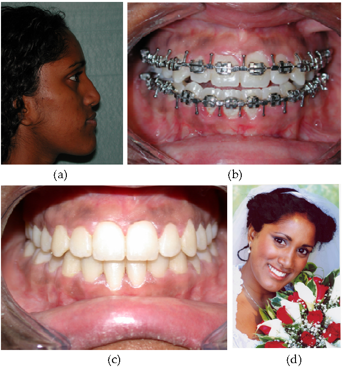 Basic and Advanced Operative Techniques in Orthognathic Surgery
