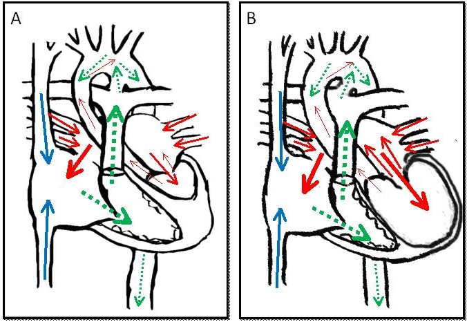Congenital Aortic Stenosis in Children IntechOpen