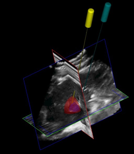 3D Ultrasound Imaging in ImageGuided Intervention IntechOpen