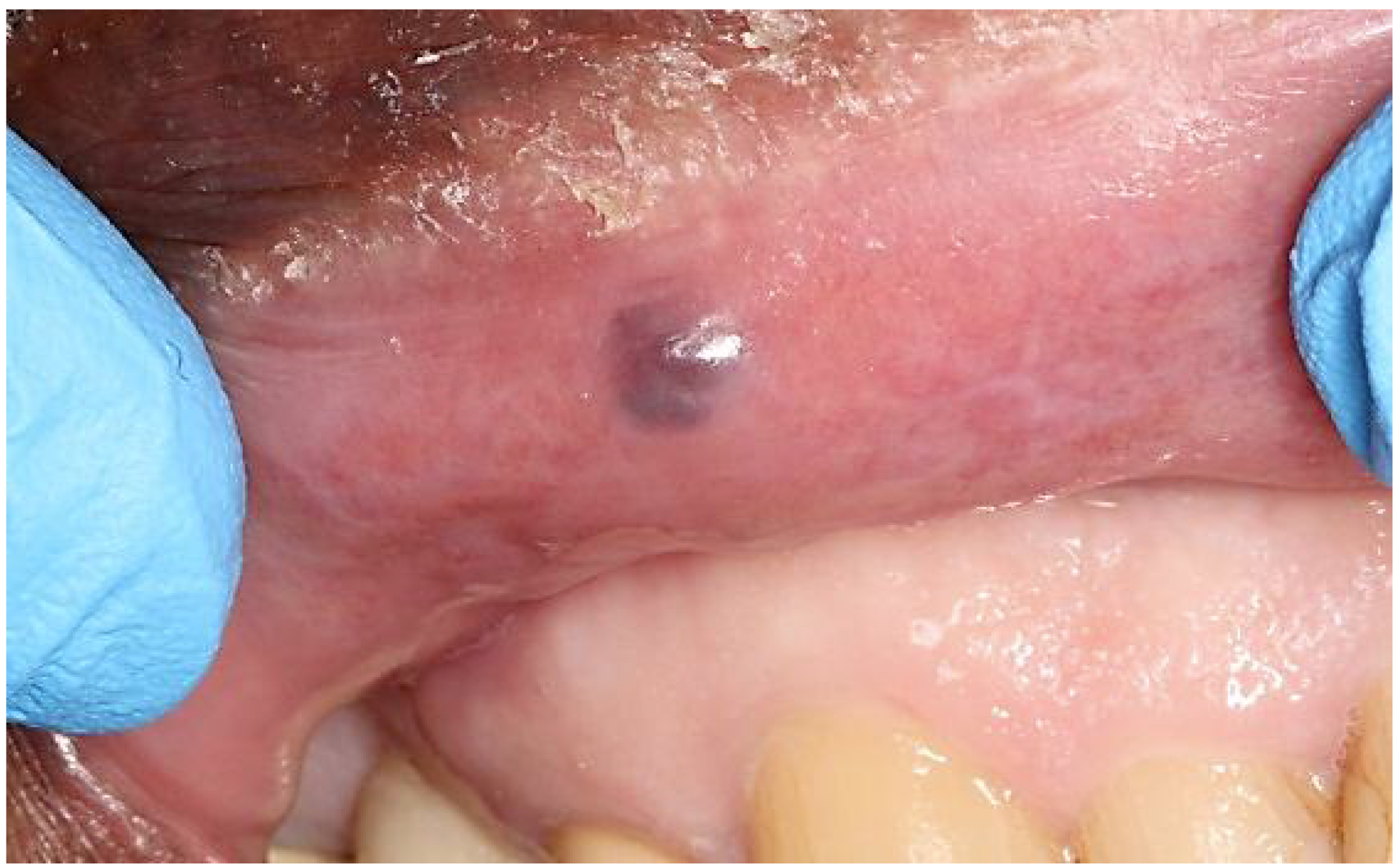 Normal Oral Cavity Findings and Variants of Normal IntechOpen