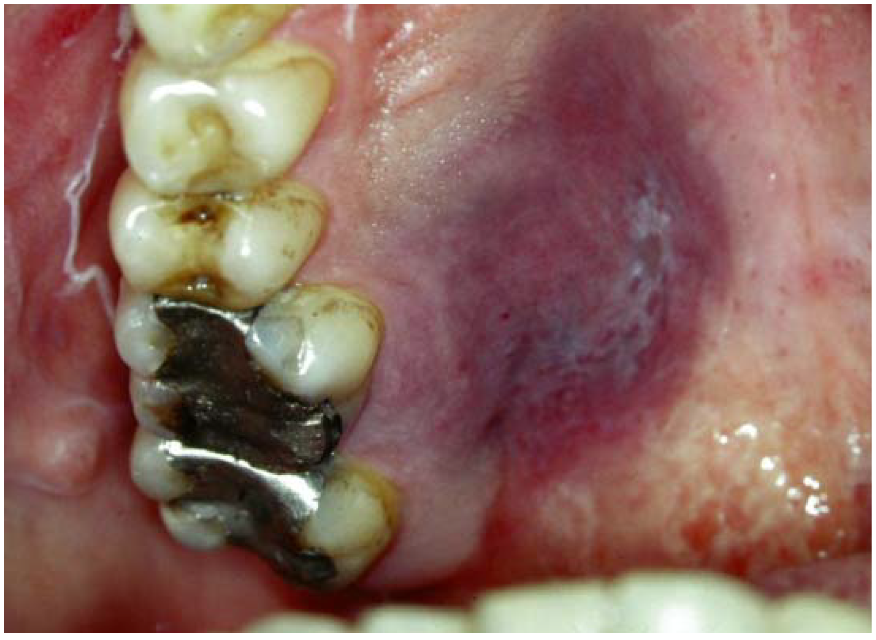 AIDS/HIV Associated Lesions and Management IntechOpen