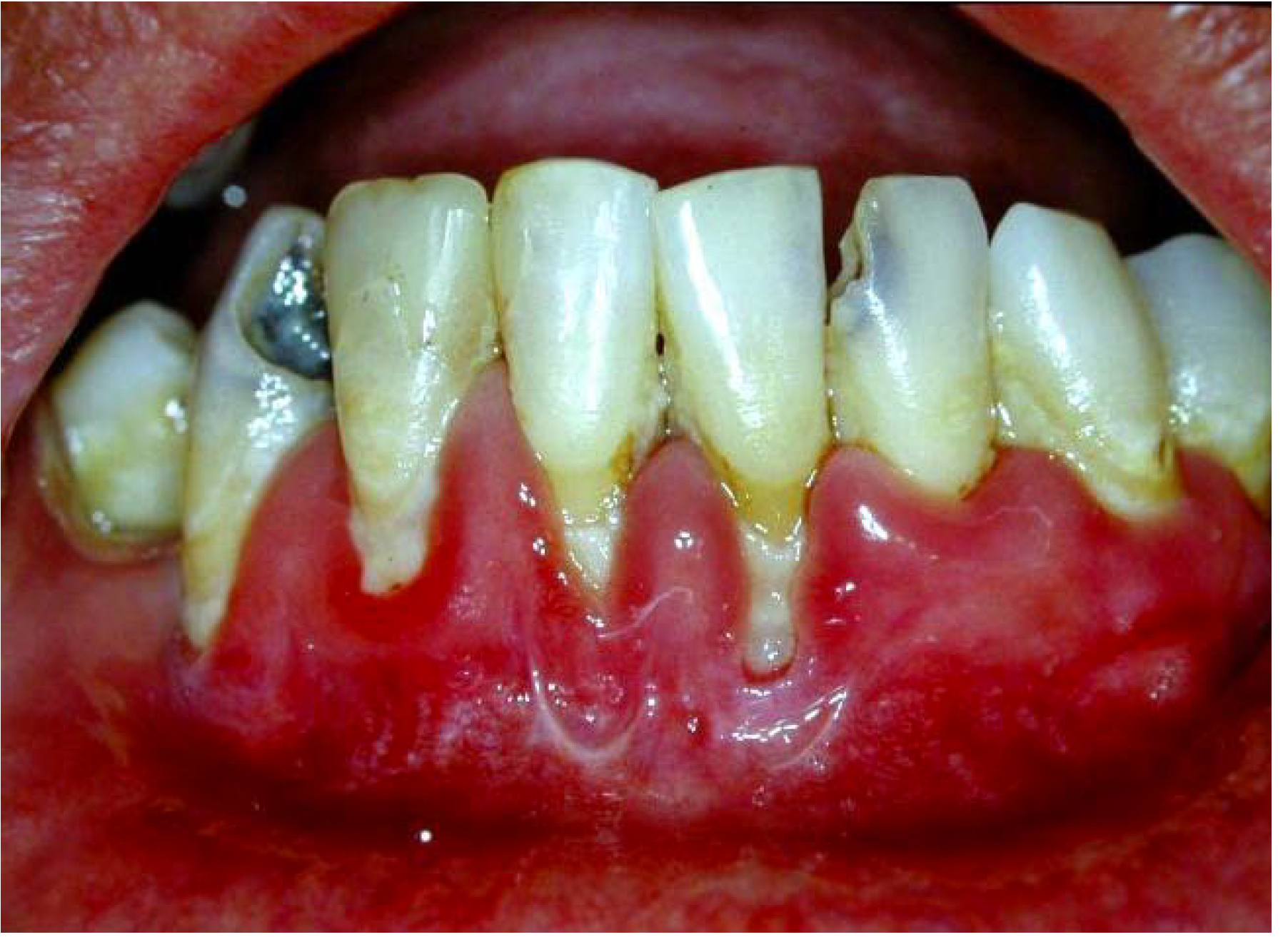 AIDS/HIV Associated Lesions and Management IntechOpen