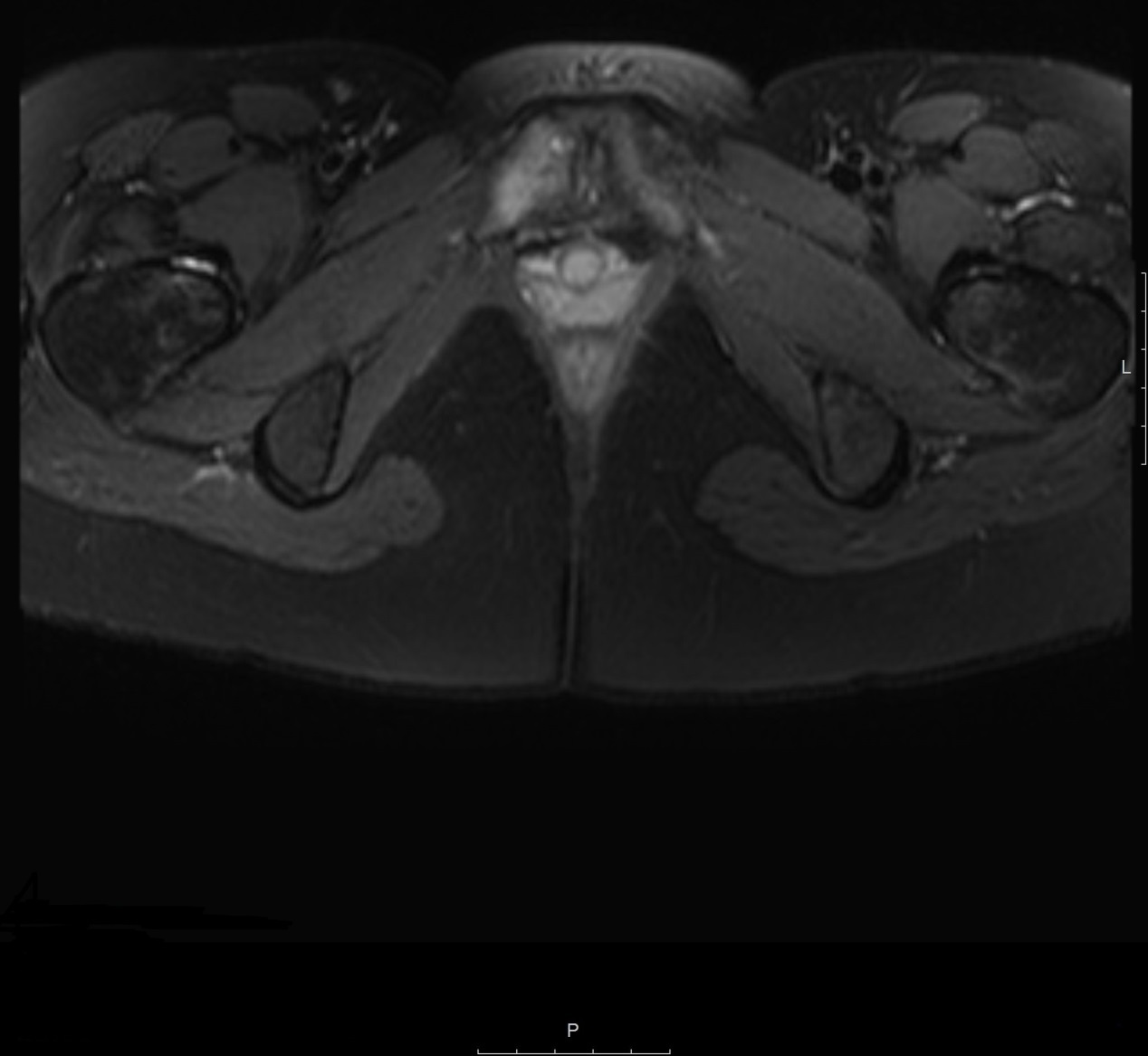 Groin Pain in Athletes — Sports Hernia and Osteitis Pubis IntechOpen
