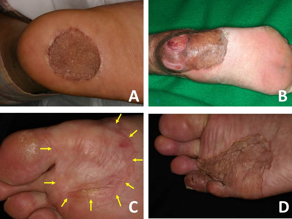 Current Surgical Management of Acral Lentiginous Melanoma IntechOpen