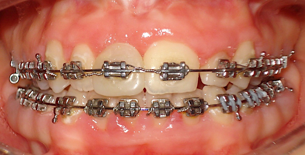 White Spots Lesions in Orthodontic Treatment and Fluoride