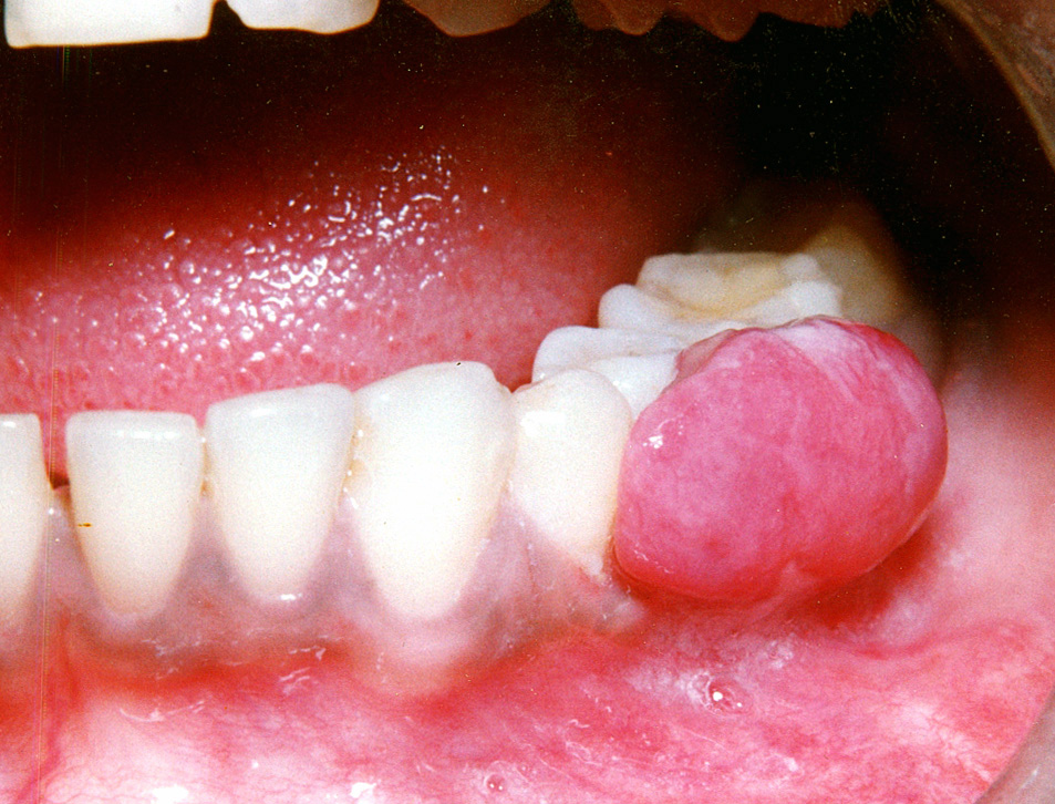 Oral Health and Adverse Pregnancy IntechOpen