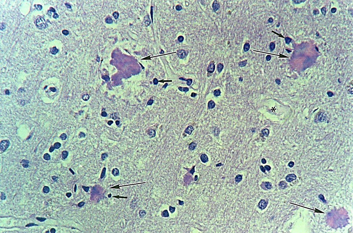 Biochemical and Histopathological Aspects of Familiar