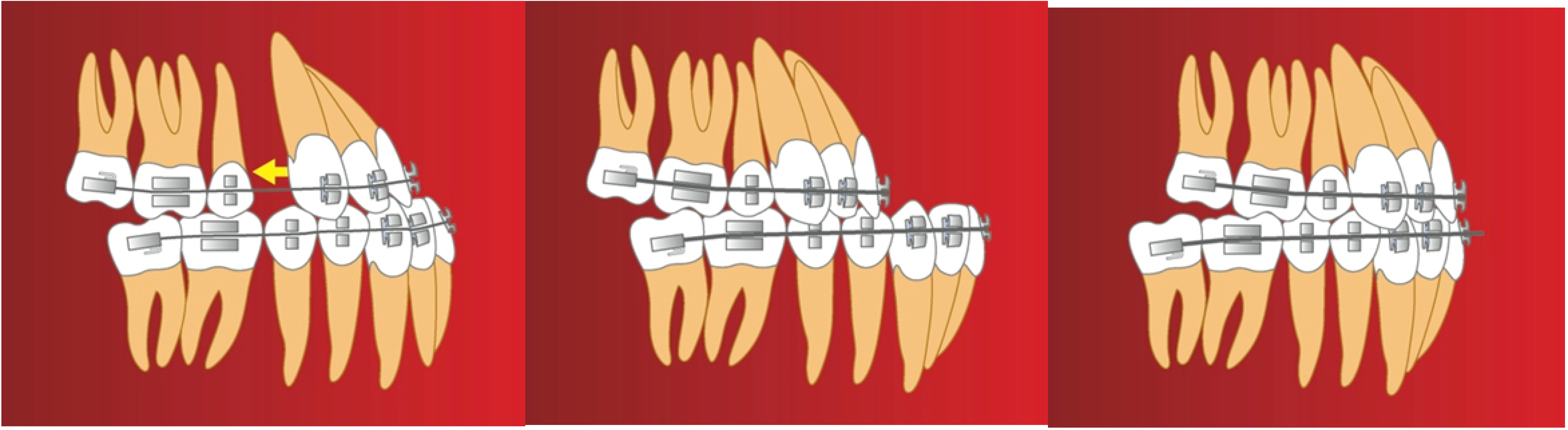 Combined Surgical and Orthodontic Management of Maxillofacial