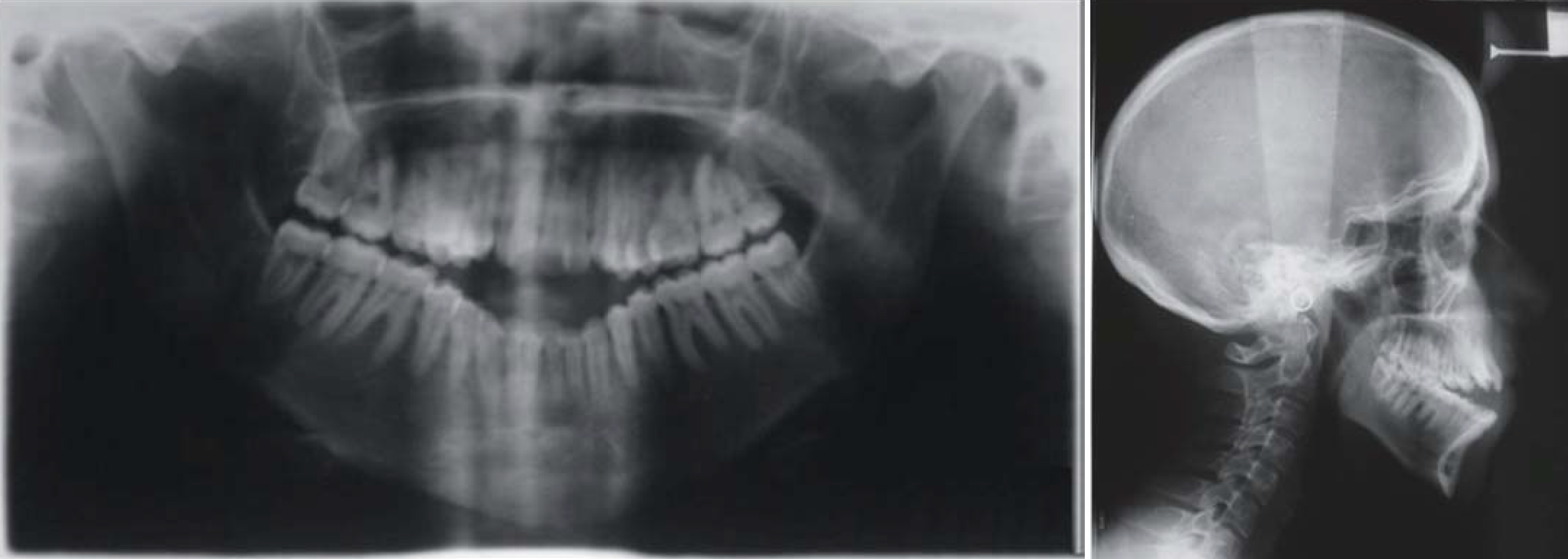Combined Surgical and Orthodontic Management of Maxillofacial