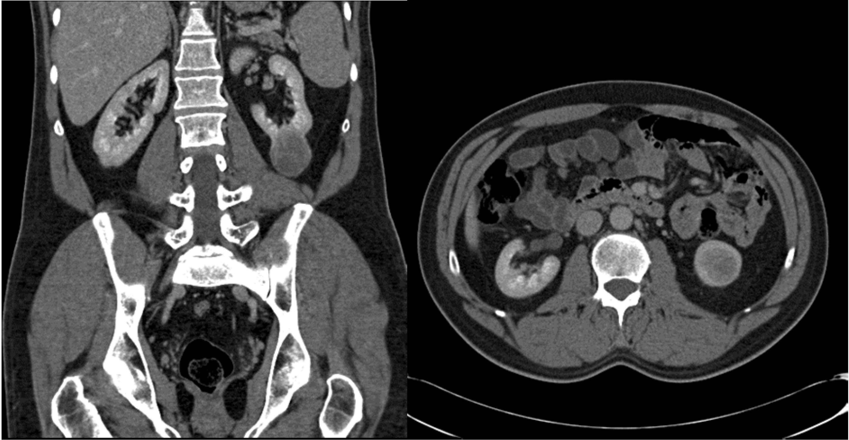 Endoscopy in Renal Cancer Organ Preservation Treatments IntechOpen