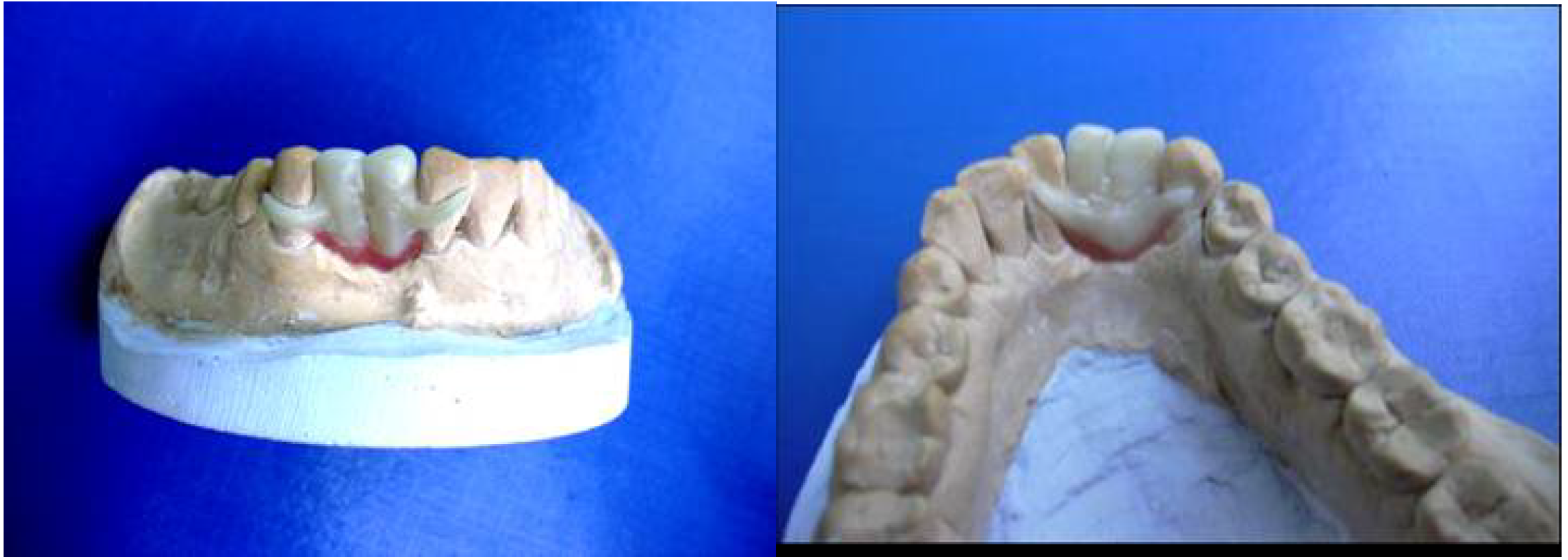 Thermoplastic Resins used in Dentistry IntechOpen